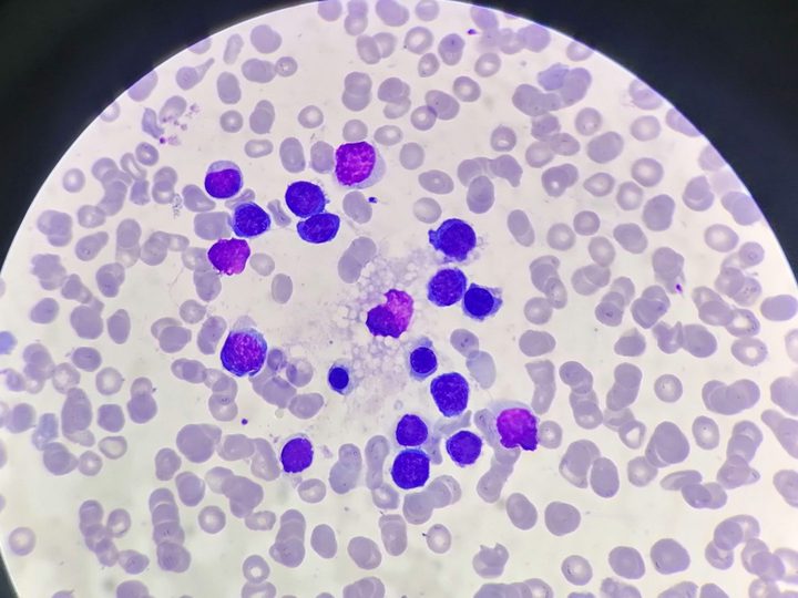 Bone marrow smear: annular arrangement of erythrokaryocytes around a macrophage