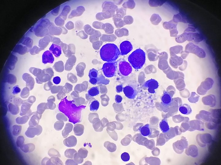 Bone marrow smear: erythroblastic island and erythroid cells