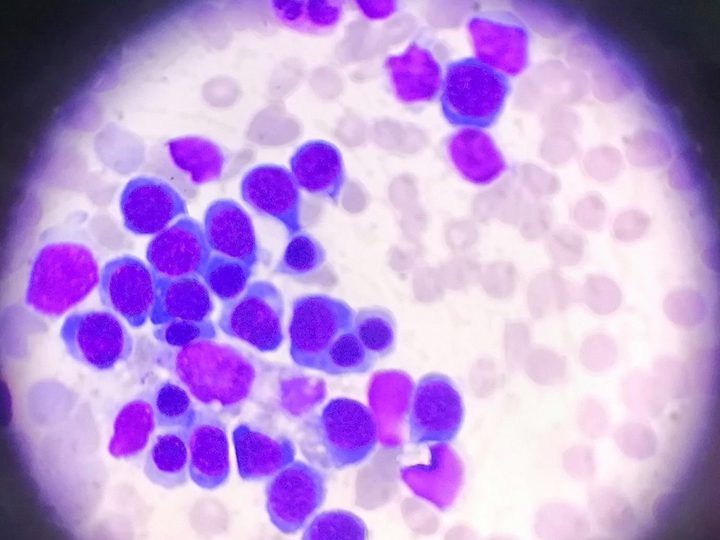 Bone marrow smear: normoblasts of different maturity around a central macrophage