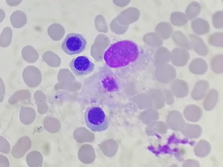Bone marrow smear: macrophage with vacuolated cytoplasm and normoblasts