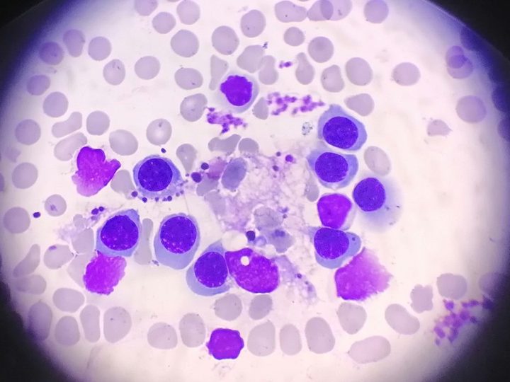 Bone marrow smear: erythroblastic island in bone marrow aspirate
