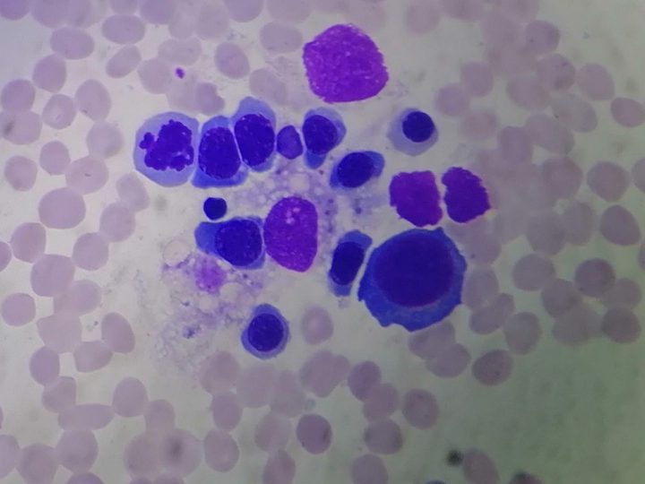 Bone marrow smear: erythrokaryocytes around a macrophage with phagocytosed material
