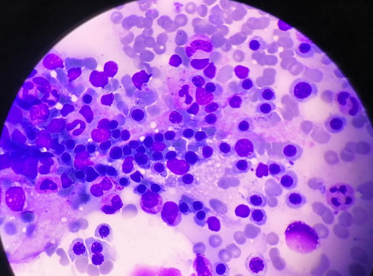Erythroblastic Island in Bone Marrow Aspirate