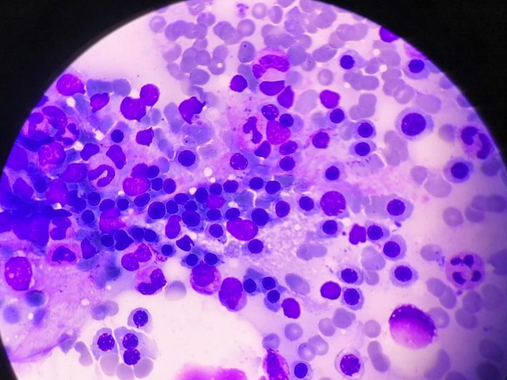 Bone marrow smear: large erythroblastic island