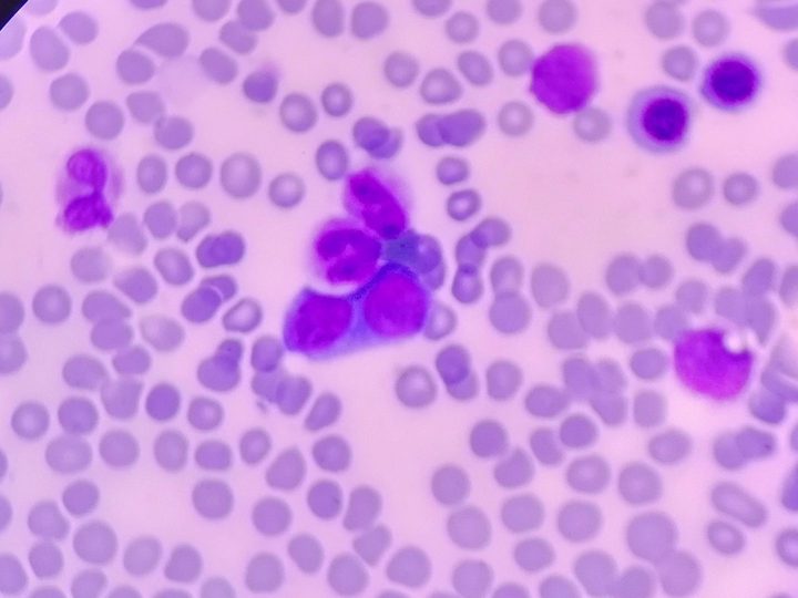 Bone marrow smear: binucleated erythrokaryocyte among cells