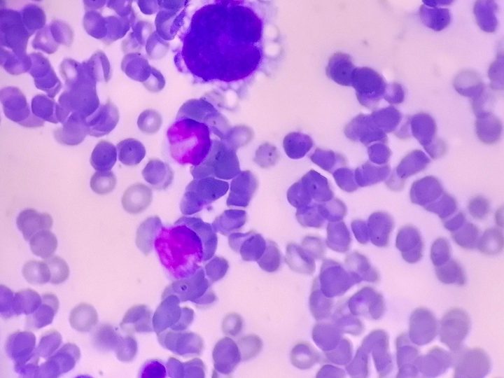 Bone marrow smear: atypical megakaryocyte under microscopy