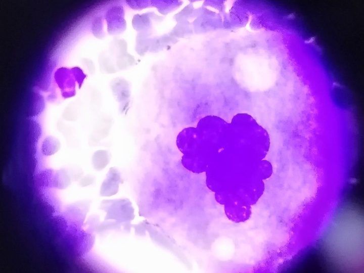 Bone marrow smear: large mature megakaryocyte with lobulated nucleus