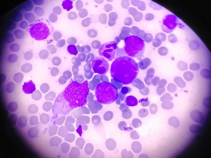 Bone marrow smear: myeloid and erythroid lineage cells