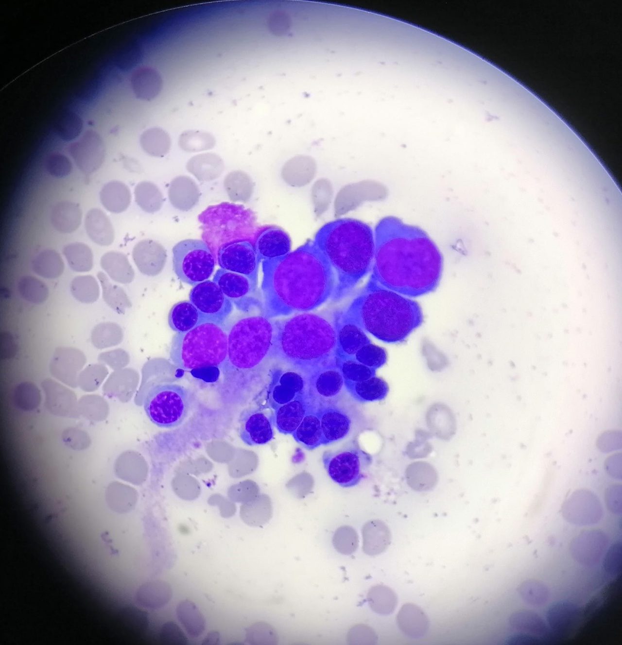Erythroblastic Island in Bone Marrow Aspirate