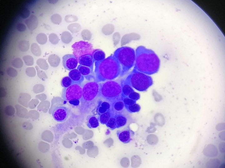 Bone marrow smear: erythroblastic island in aspirate
