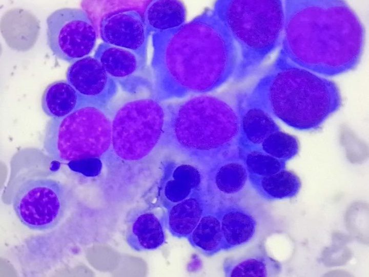 Bone marrow smear: normoblasts around a central macrophage, close-up