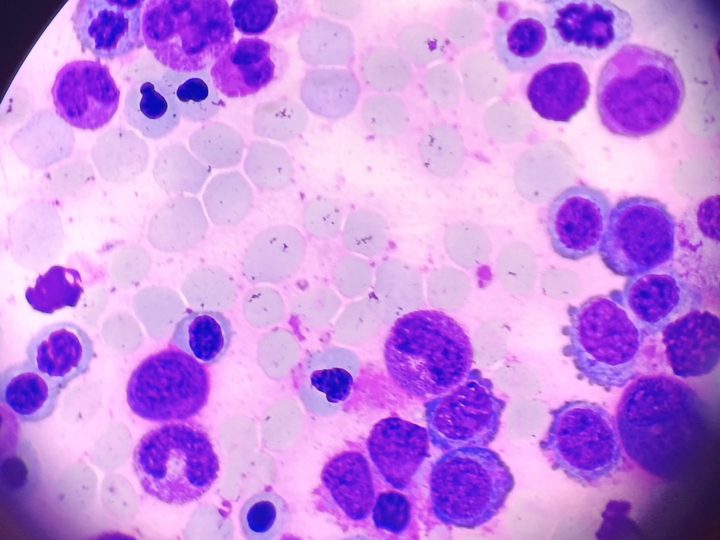 Мазок костного мозга: эритрокариоциты и гранулоциты в поле зрения