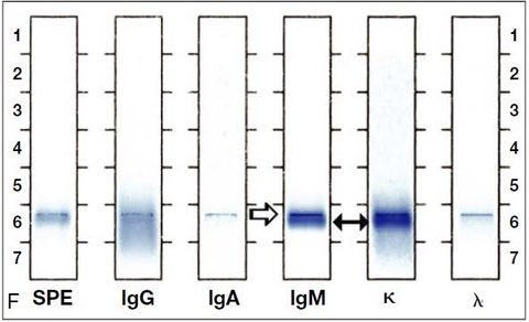 Смешанный криоглобулин II типа: моноклональный IgM-каппа и поликлональный IgG