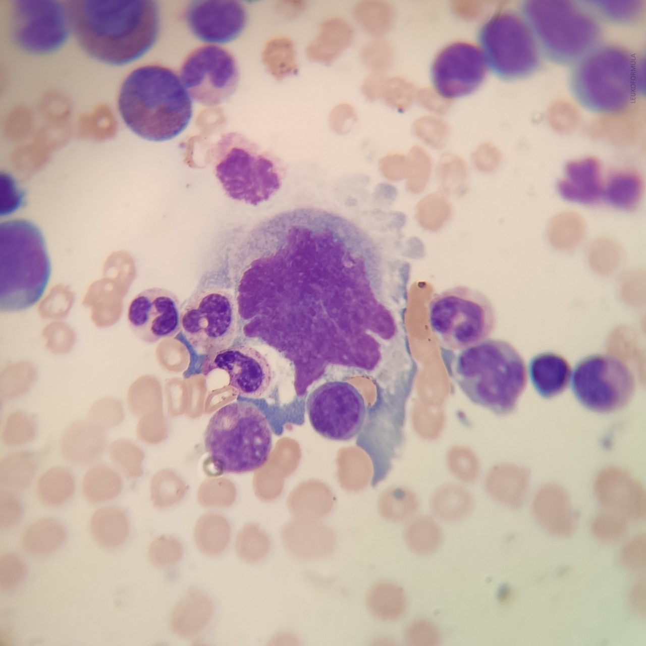 Emperipolesis Phenomenon in Bone Marrow Smear