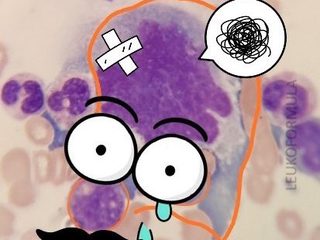 Bone marrow smear with graphic illustration of the emperipolesis phenomenon