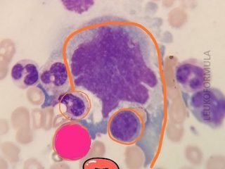 Bone marrow smear highlighting the contours of engulfed cells in the cytoplasm