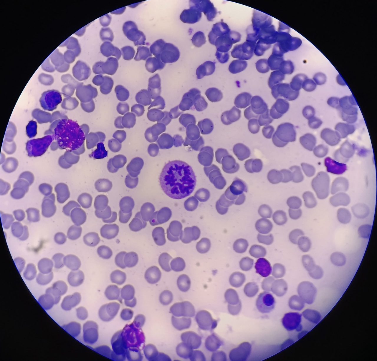 Mitotic Figures in Bone Marrow Aspirate Smears