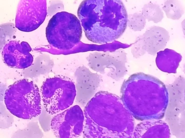 Bone marrow smear: mitotic figure at anaphase stage among granulocytes