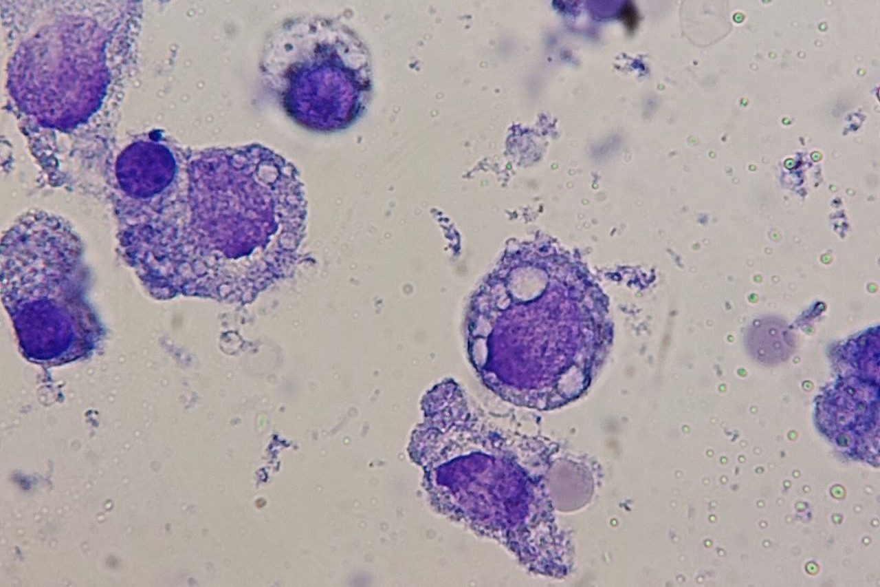 Galactosemia: Bone Marrow Cell Vacuolization