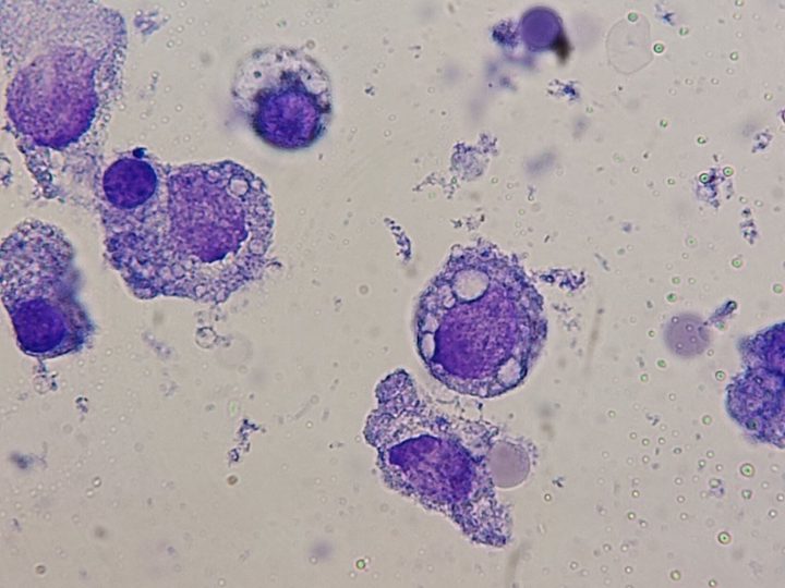 Bone marrow smear: vacuolization and inclusions in cell cytoplasm