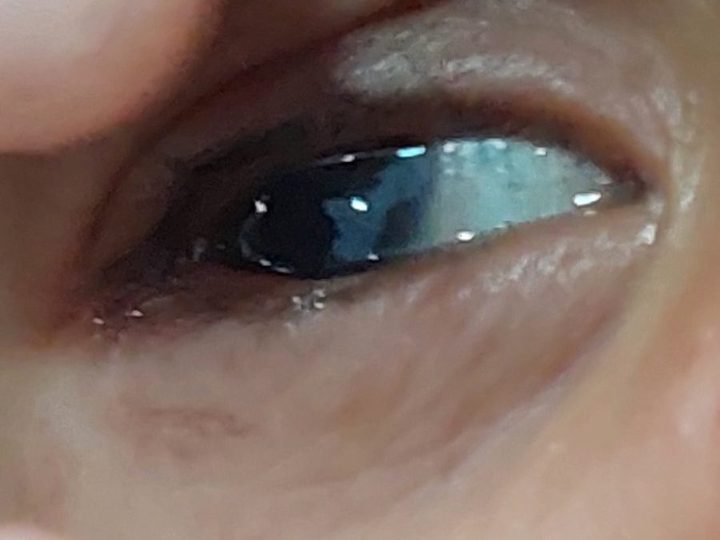 Clinical photo: lens opacity (cataract) in an infant