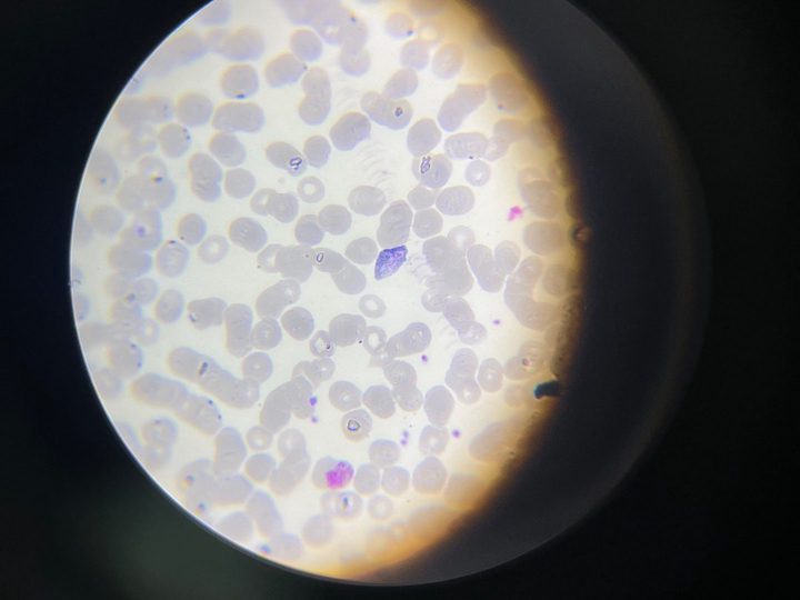 Мазок крови, поле зрения микроскопа: гаметоцит Plasmodium в центре