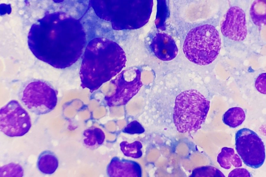 Canine Hemophagocytic Histiocytic Sarcoma: Cytology