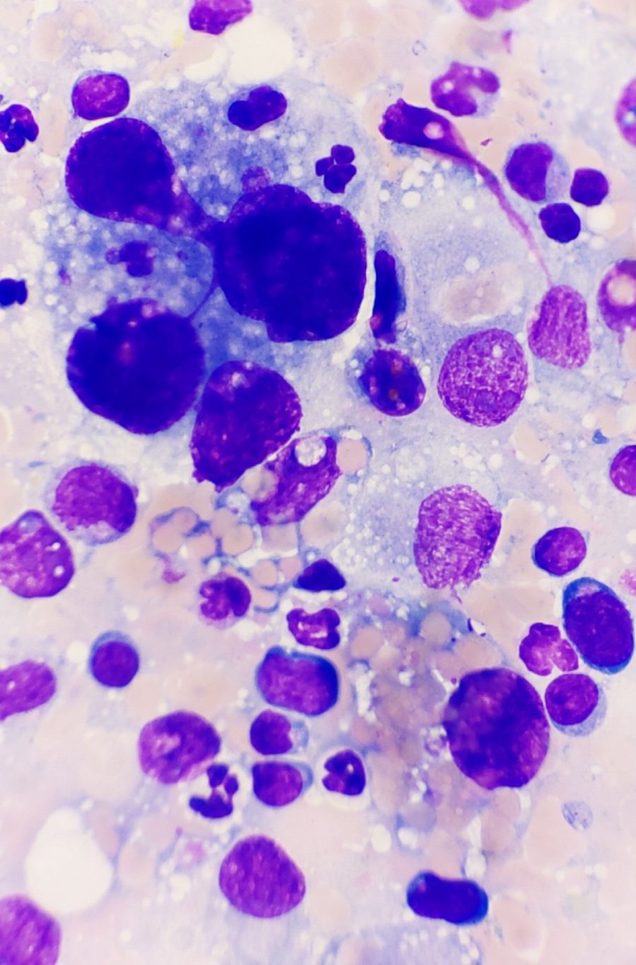Canine Hemophagocytic Histiocytic Sarcoma: Cytology