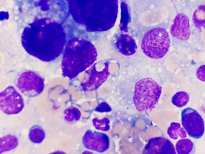 Lymph node aspirate cytology: atypical histiocytes with signs of hemophagocytosis