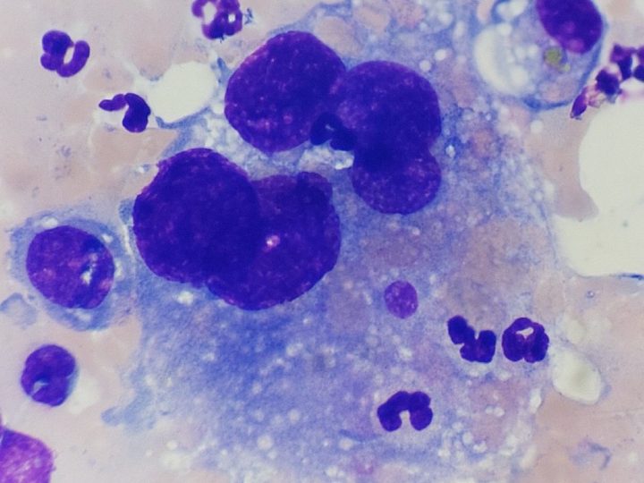 Lymph node aspirate cytology: multinucleated histiocyte with signs of erythrophagocytosis