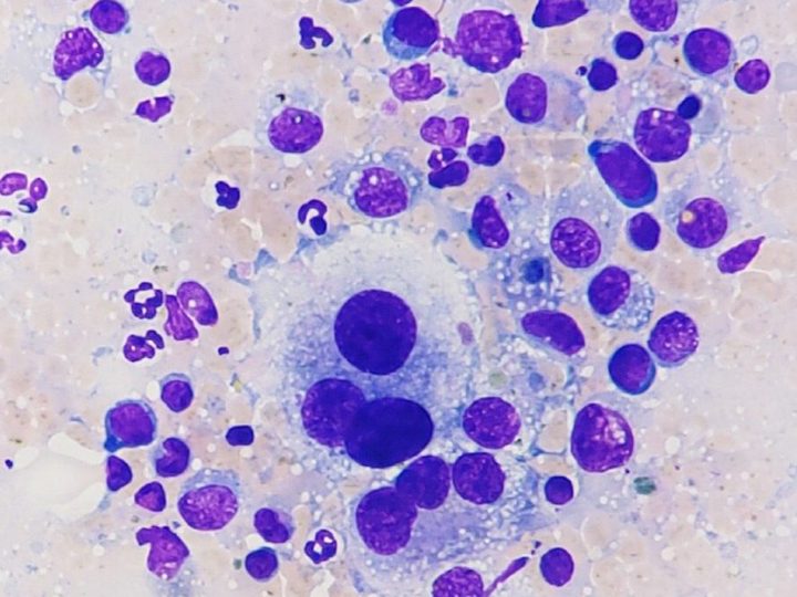 Lymph node aspirate cytology: large histiocyte among polymorphic lymphoid cells