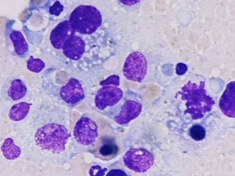 Lymph node aspirate cytology: neoplastic histiocyte, erythrophagocytosis, and mitotic figure