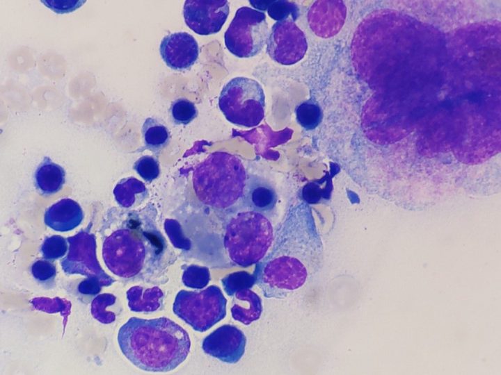 Bone marrow smear cytology: megakaryocyte and erythroid hyperplasia