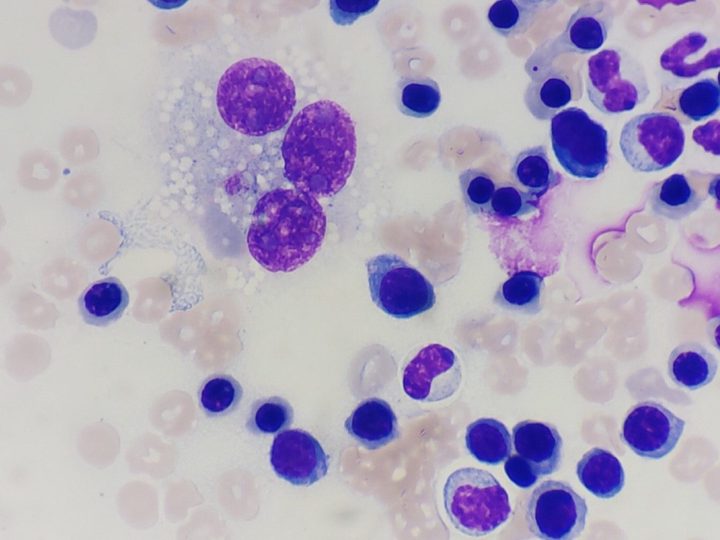 Bone marrow smear cytology: multinucleated neoplastic histiocyte and normoblasts