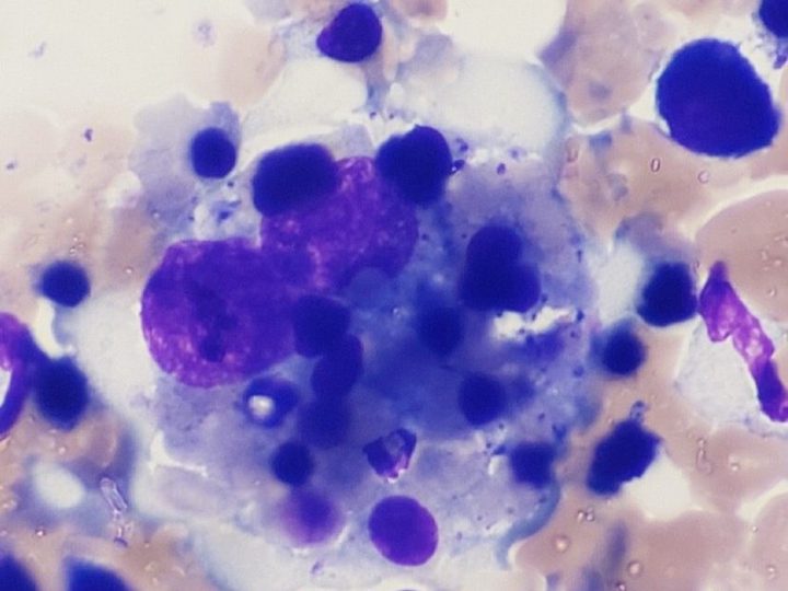 Bone marrow smear cytology: active hemophagocytosis by a large atypical histiocyte
