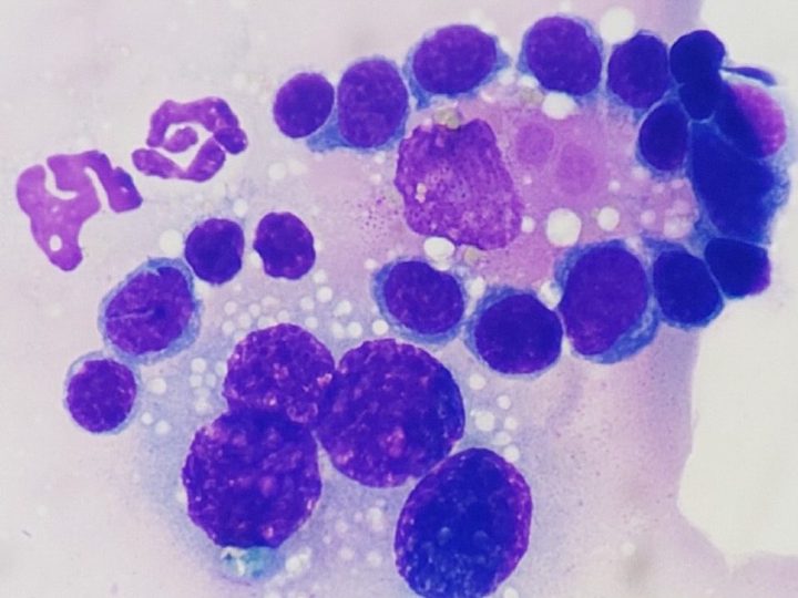 Bone marrow smear cytology: cluster of erythrocaryocytes and a macrophage with phagocytosis