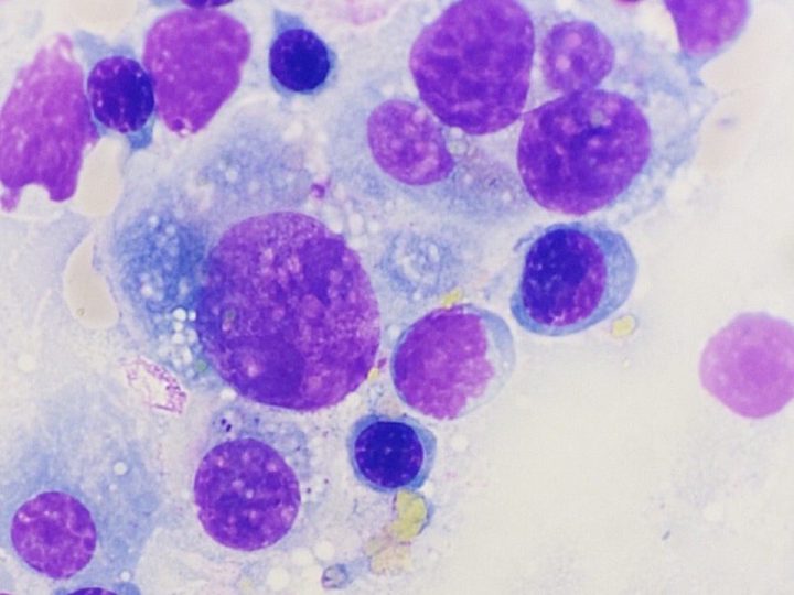 Bone marrow smear cytology: marked cell pleomorphism and cytoplasmic vacuolization