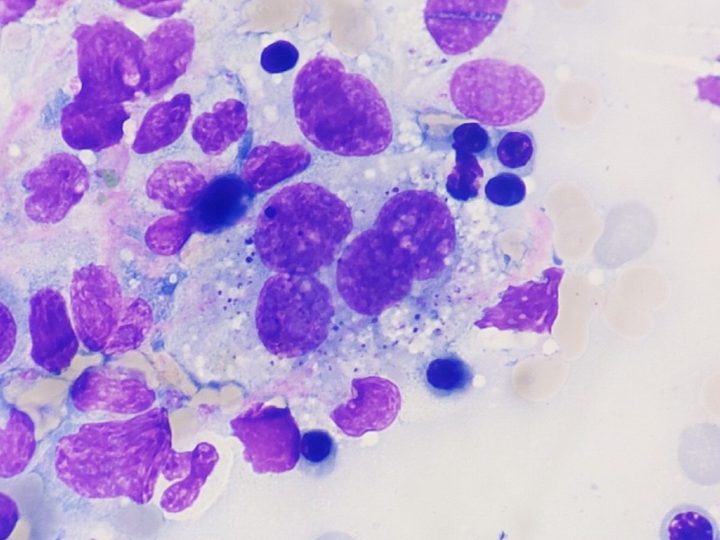 Bone marrow smear cytology: atypical histiocyte with phagocytized erythrocytes