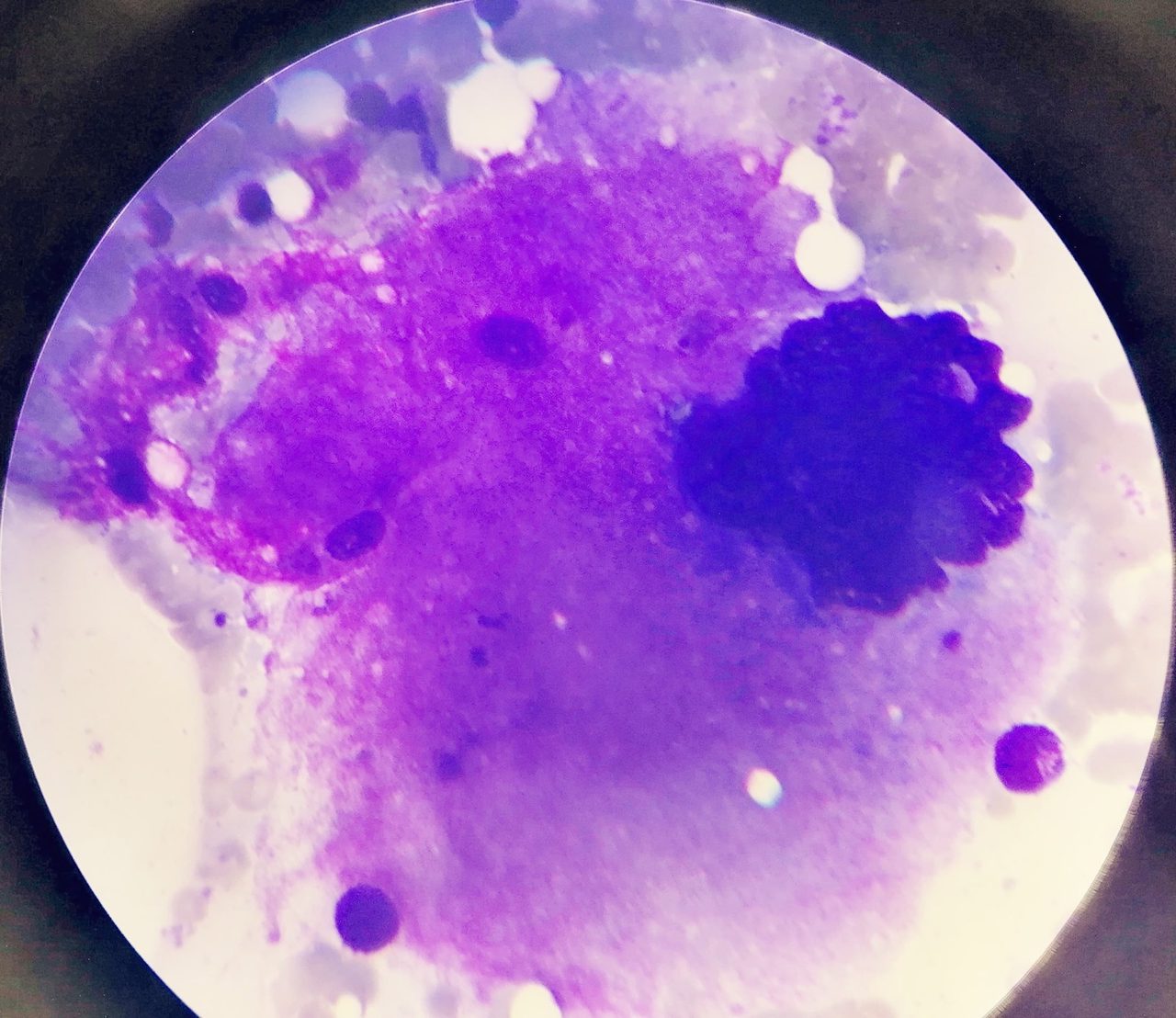 Giant Megakaryocytes in Bone Marrow with Thrombocytosis