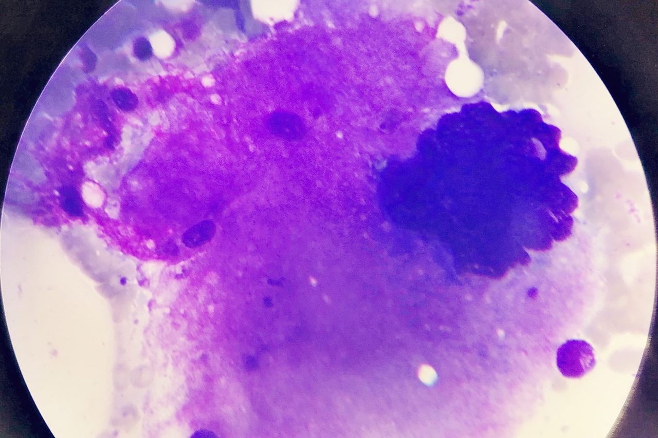 Giant Megakaryocytes in Bone Marrow with Thrombocytosis