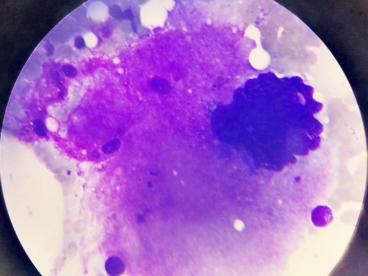 Bone marrow smear: giant mature megakaryocyte with abundant cytoplasm