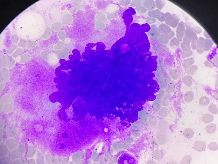 Bone marrow smear: megakaryocyte with pronounced hyperlobulated nucleus