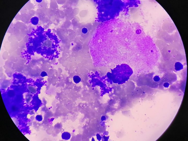 Bone marrow smear: megakaryocyte amidst erythroid and granulocytopoietic cells