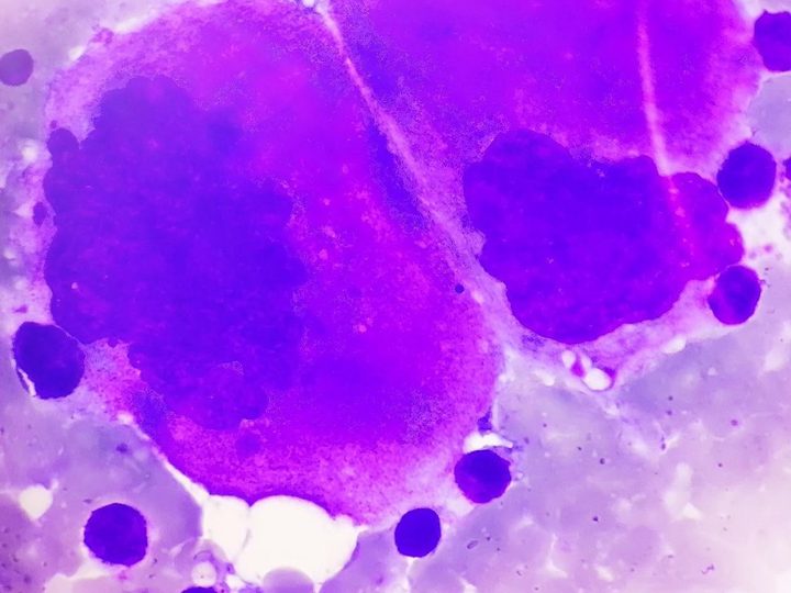 Bone marrow smear: two giant megakaryocytes with polyploid nuclei