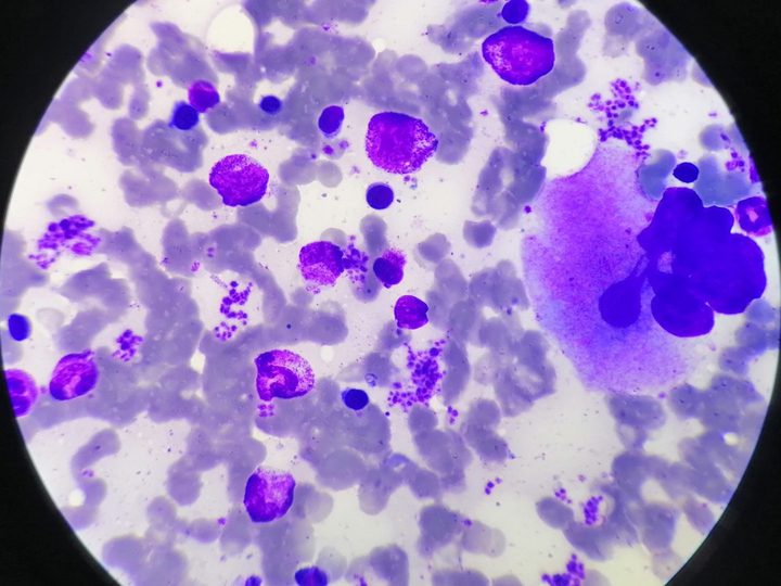 Bone marrow smear: megakaryocyte surrounded by myeloid progenitor cells