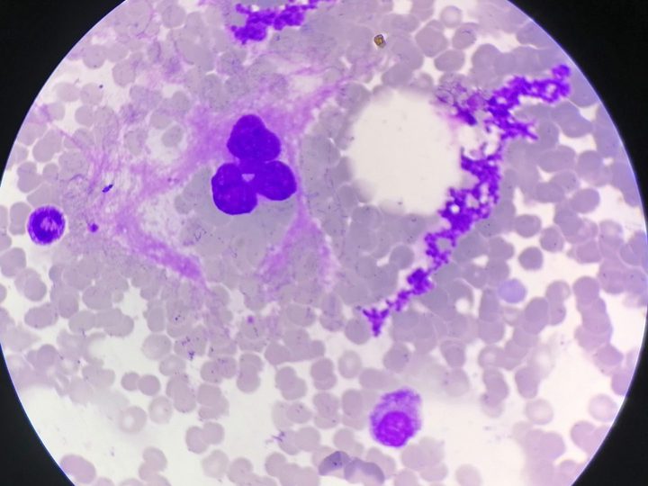 Bone marrow smear: mature megakaryocyte with hypersegmented nucleus