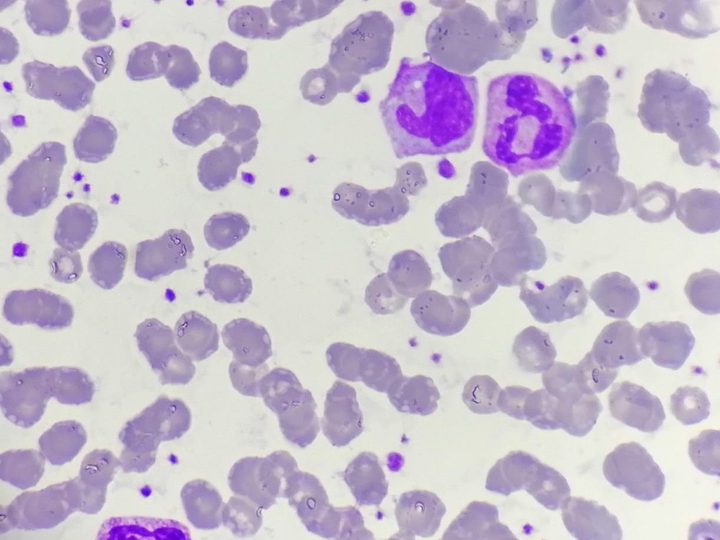 Blood smear: platelet clumps, band and segmented neutrophils