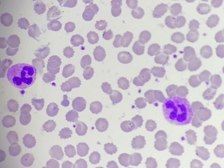 Blood smear: pronounced thrombocythemia in fields of view, mature granulocytes