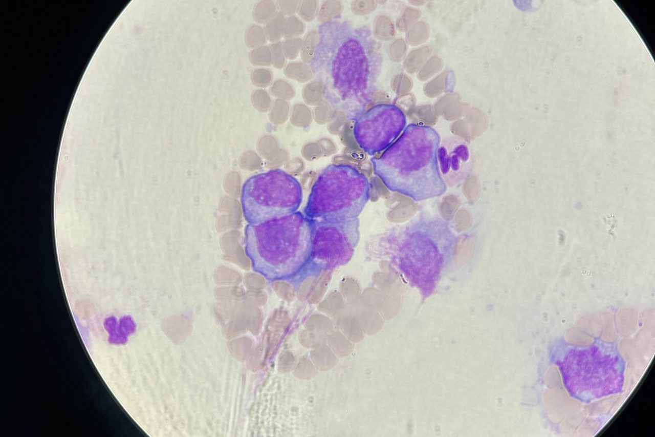 Giant Plasma Cells in Blood Smear: Morphology and Location