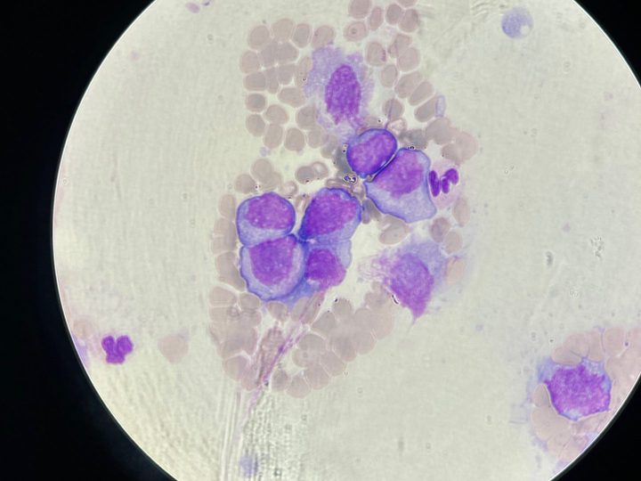 Blood smear: cluster of giant plasma cells